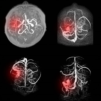 animated Thromboembolism with four examples
